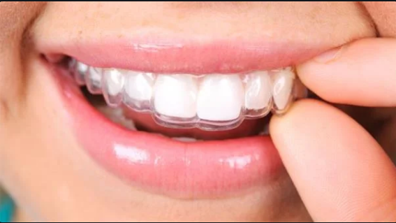 Diş Teline Gerek Kalmadan Dişteki Çapraşıklığı Düzelten Plak Tedavisi  Invisalign