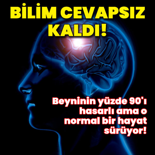 Beyninin yüzde 90 ı hasarlı ama o normal bir hayat sürüyor Bilim cevapsız kaldı